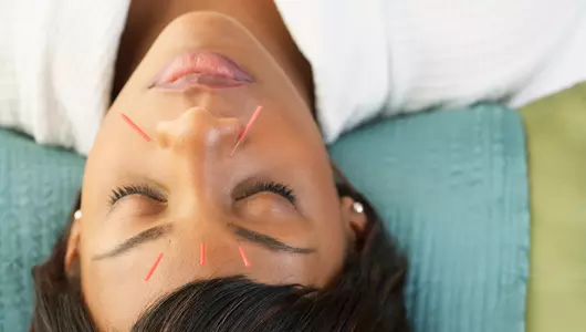 Woman with brown hair with acupuncture needles.