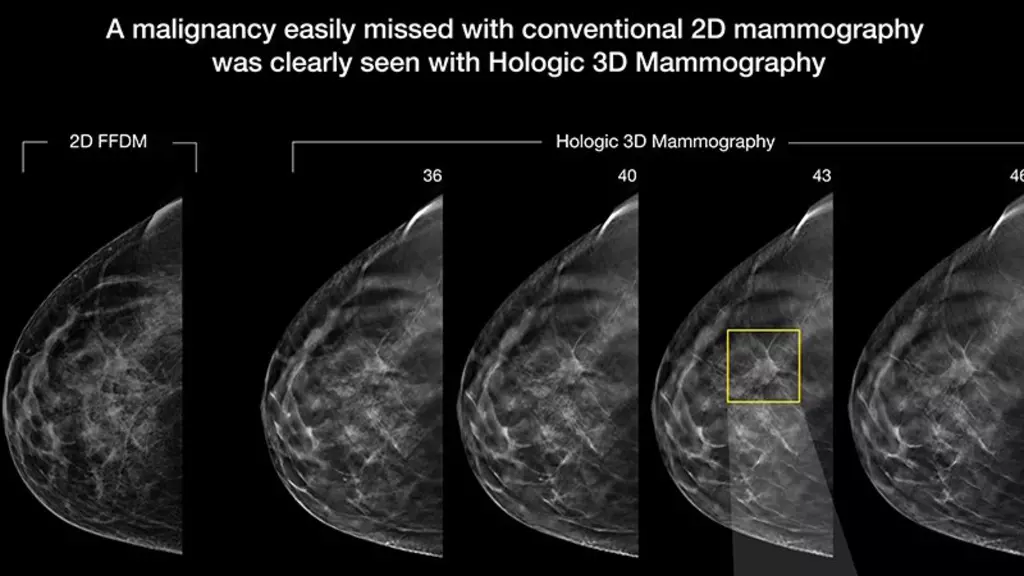 3D mammography now available in Onalaska