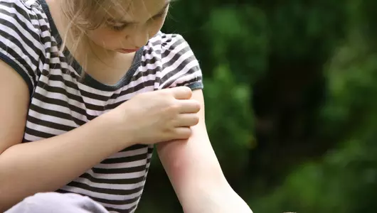 young girl itching mosquito bite on her arm