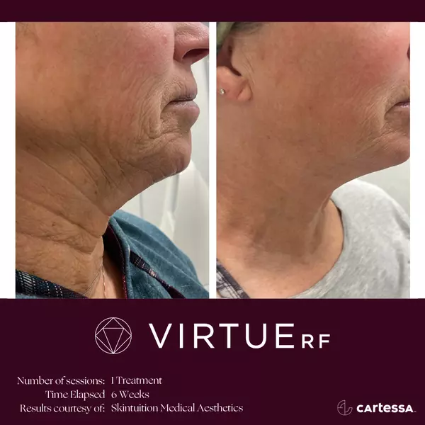 Radiofrequency (RF) microneedling before and after
