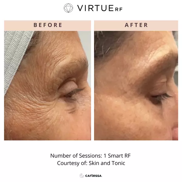 Radiofrequency microneedling Virtue Before and After